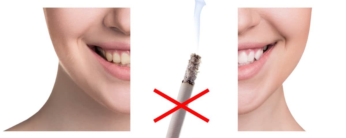 Quel est l’effet de la cigarette électronique sur les dents ?